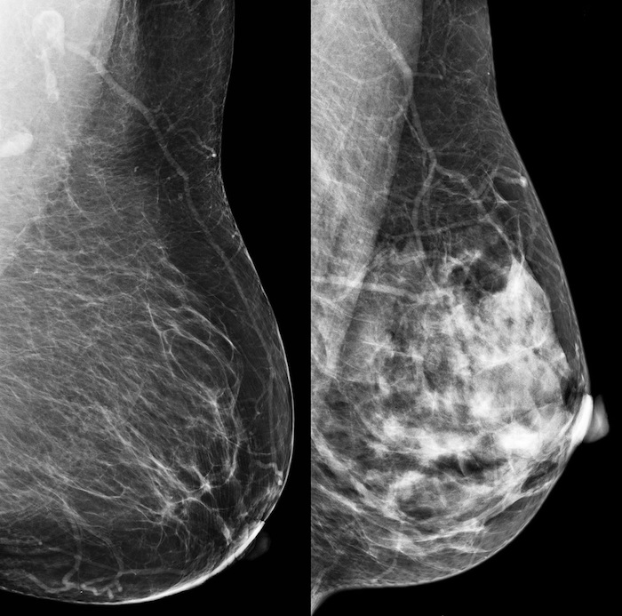 USPSTF新建議：乳腺癌篩查應從40歲開始